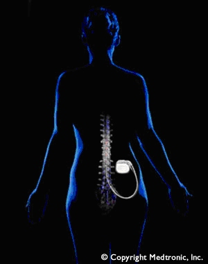 Schematische Darstellung der Neuromodulation