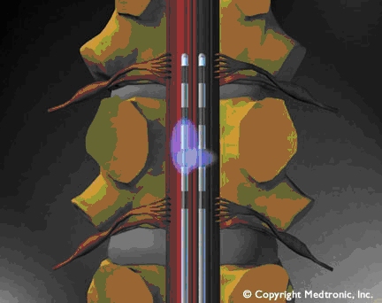 Schematische Darstellung der Neuromodulation – Detailvergrößerung